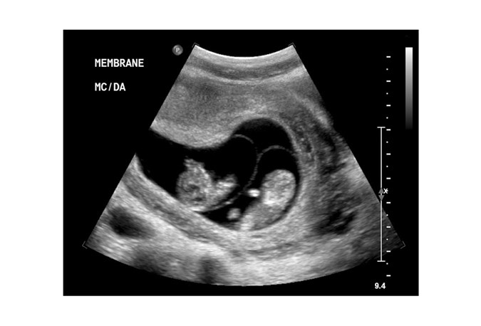 Image: A Monochorionic Twins ultrasound, showing identical twins that share a placenta.