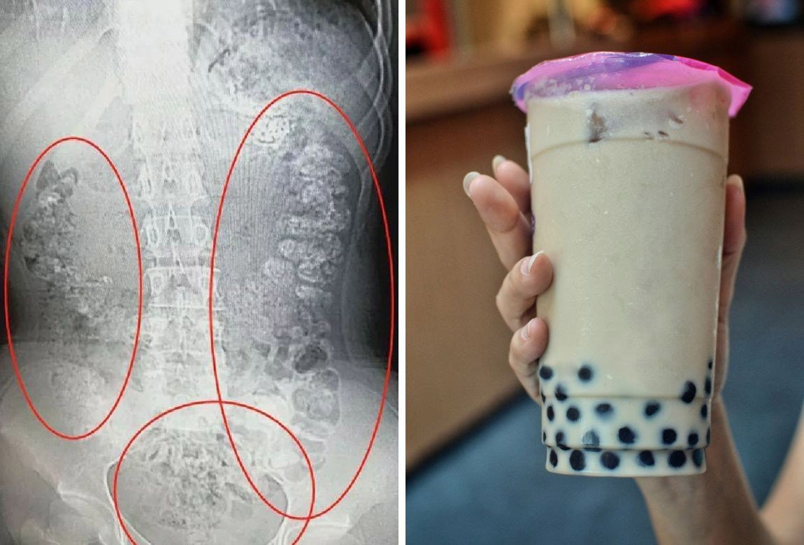 Why a Singapore hospital is warning that bubble milk tea is bad