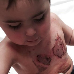 Mom Shares Warning After Baby Burned in Crock Pot Accident