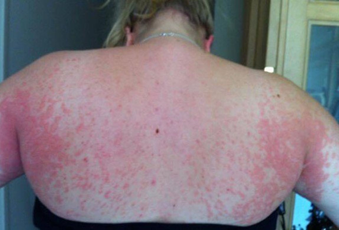 Mum developed painful rash while pregnant | Practical Parenting Australia