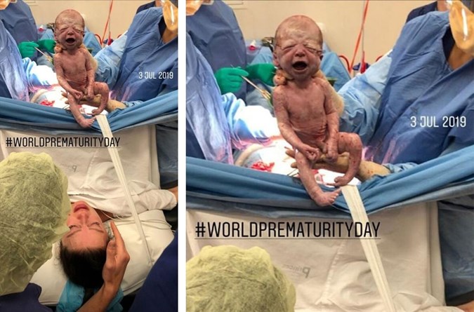 Despite being born 7 weeks early, Laila is a healthy baby now. Image: Instagram